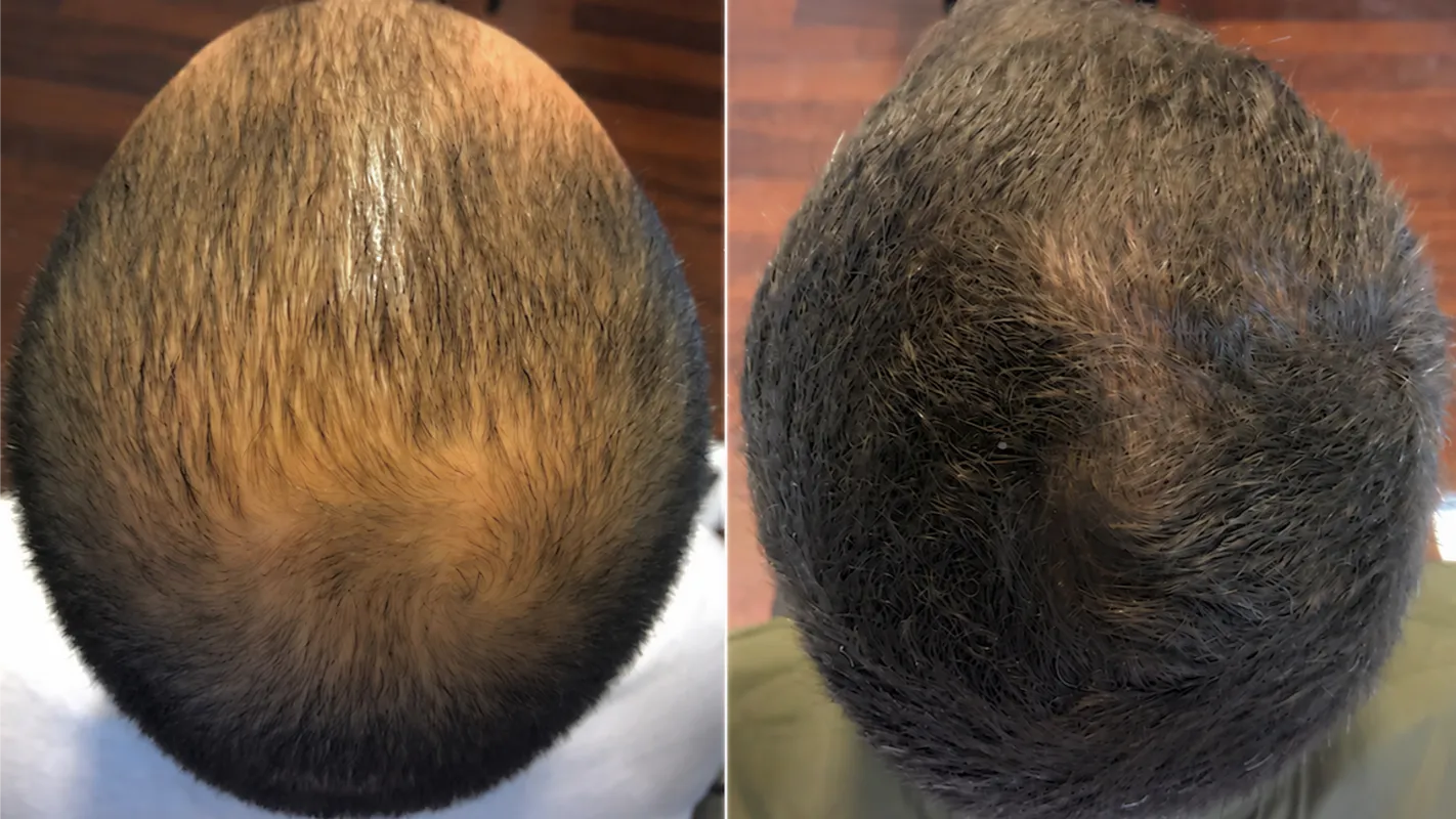 Prima e dopo il percorso HairClinic — caso 2