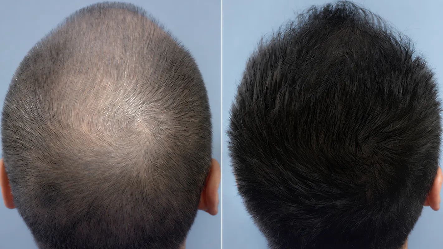 Prima e dopo il percorso HairClinic — caso 3