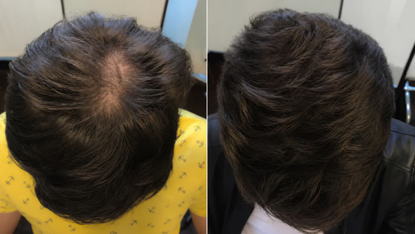 Prima e dopo il percorso HairClinic — caso 4